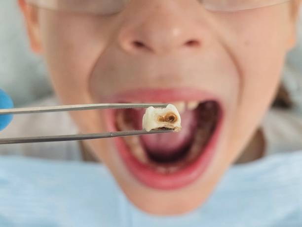 Best Emergency Wisdom Teeth Removal in Crown Pot, IN