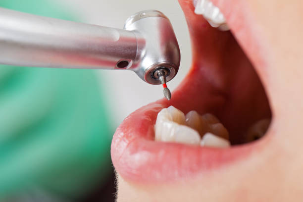 Best Emergency Dental Surgery in Crown Pot, IN